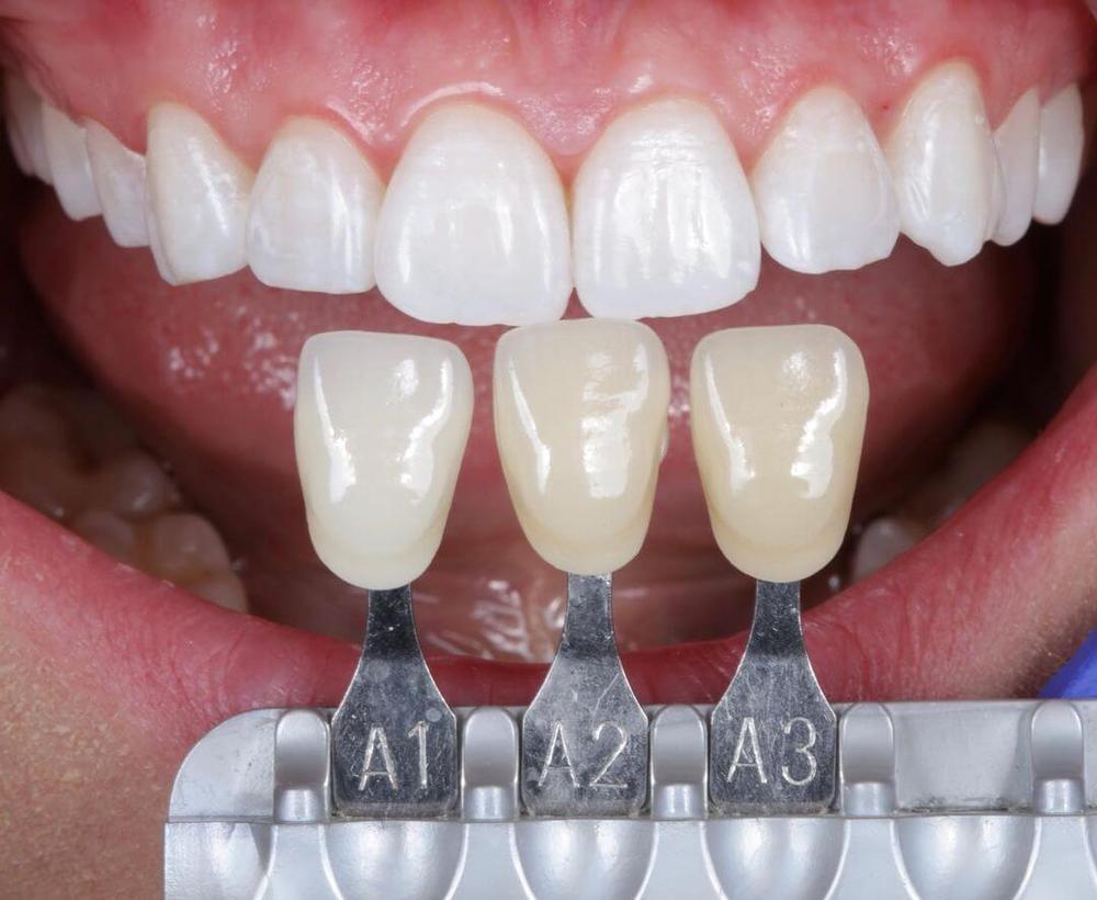 Teeth Whitening
